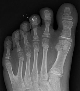 Kuudes varvas röntgenkuvassa (Wikimedia Commons),